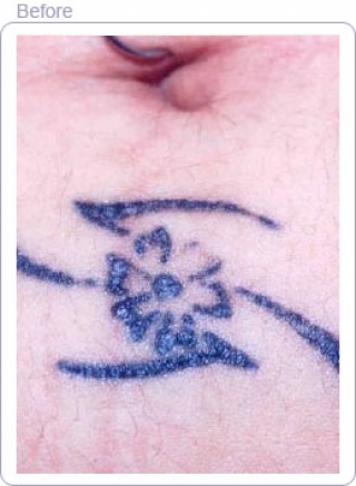 tattoo removal before and after. Tattoo before removal. After