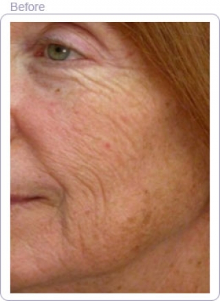 Sowave Earlier than And After Facial Wrinkle Reduction Treatment Results