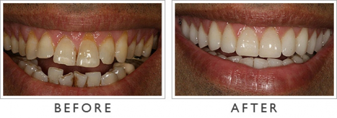 Before After Pictures Of Veneers 17